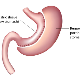 Illustration of the Laparoscopic VSG procedure